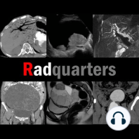 Hepatic Hemangioma: Pitfalls & Mimics, Part II