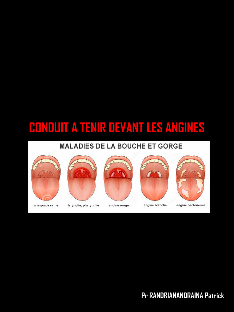 1 - Conduit A Tenir Devant Les Angines | PDF | Immunologie | Maladies ...