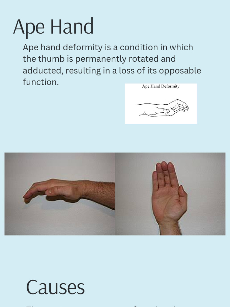 Ape Hand - 20251216 - 133610 - 0000 | PDF | Hand | Thumb