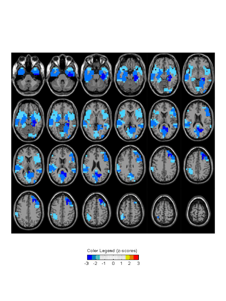 Neuroguide EO LinkedEars Loreta | PDF | Electroencephalography ...