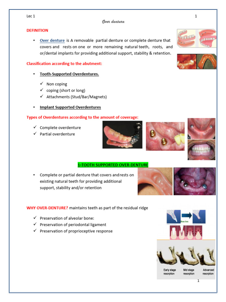 Lec 1 Over Denture | PDF | Dental Implant | Dentures