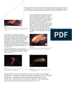 Common Gonioscopy Findings