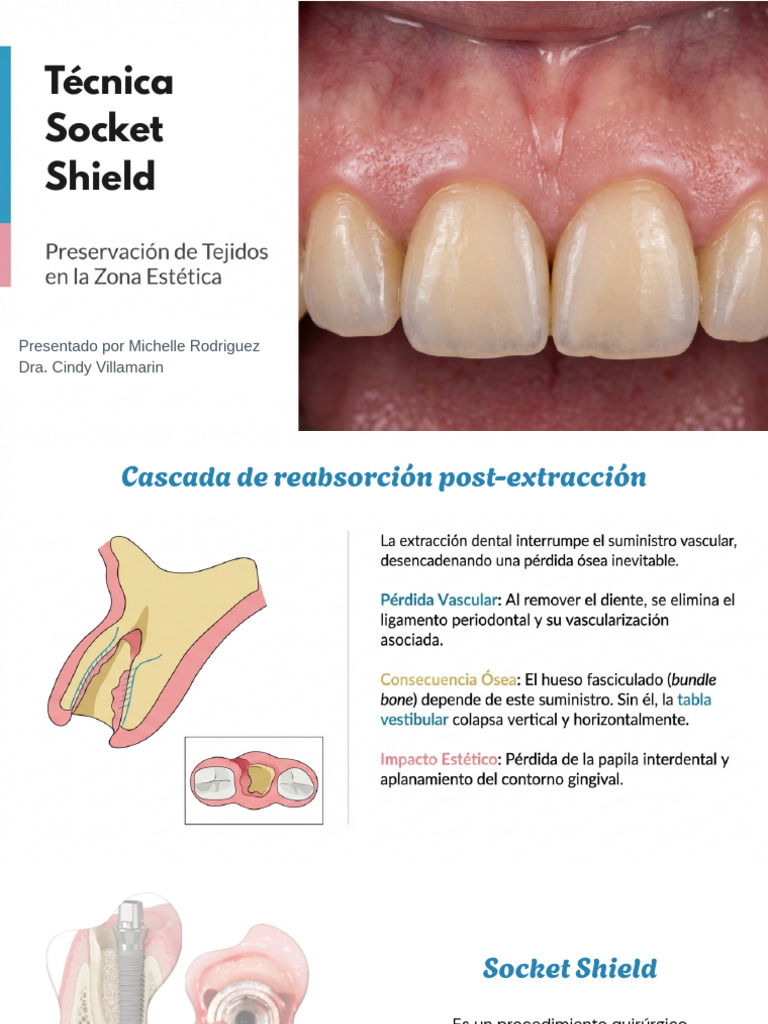 Socket Shield Technique | PDF | Odontología
