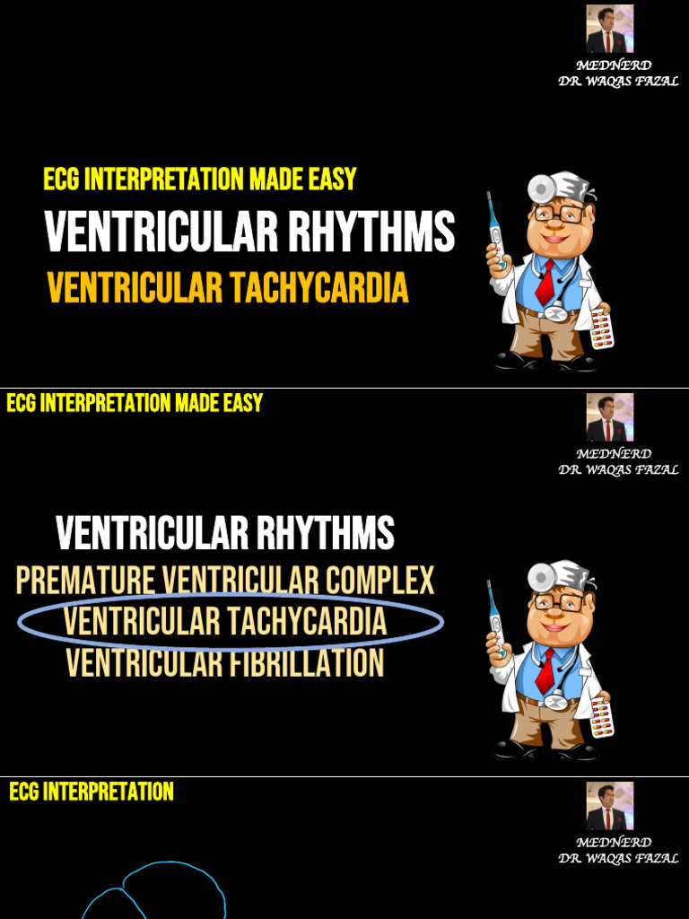 Ventricular Tachycardia VT ECG Lecture 9 | PDF | Electrocardiography ...