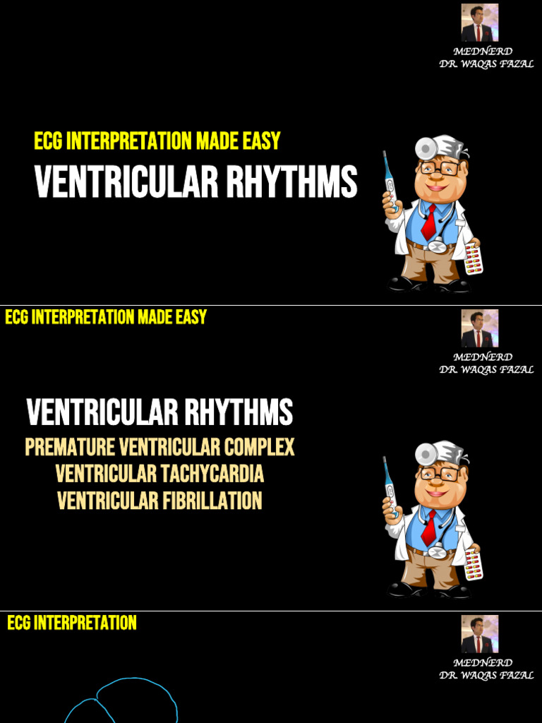 Premature Ventricular Complexes Contraction ECG 8 | PDF ...