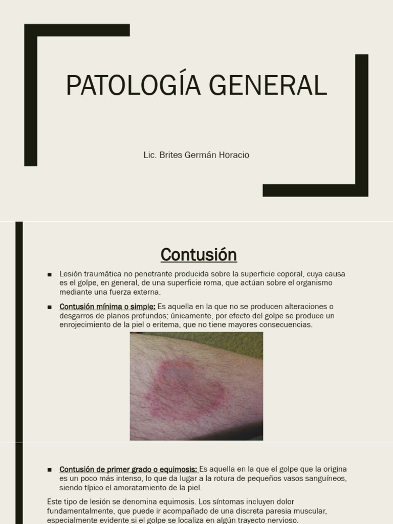 Patología GENERAL - Contusión, Desgarros, Esguinces | PDF | Músculo ...