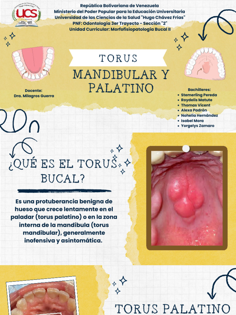 Diapositiva Torus Palatino y Mandibular | PDF | Medicina CLINICA ...