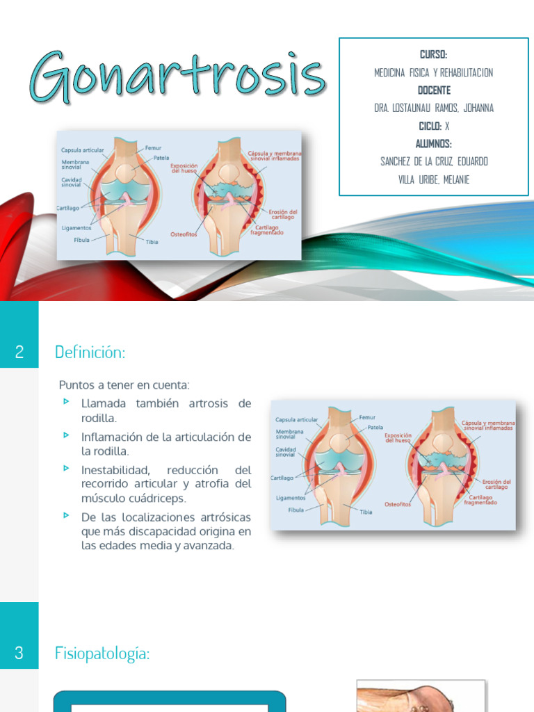 Gonartrosis | PDF | Rodilla | Dolor