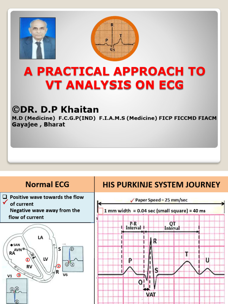 VT Analysis ECG DR D P Khaitan CME India | PDF | Electrocardiography ...