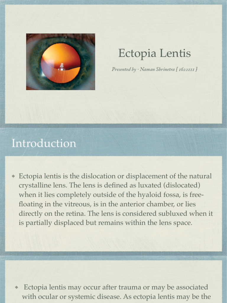 Ectopia Lentis | PDF | Glaucoma | Cataract