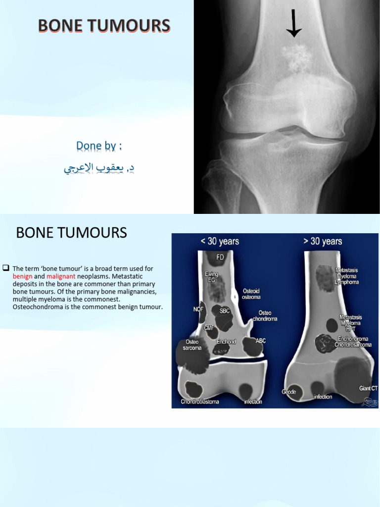 bone tumer (1) | PDF | Benign Tumor | Neoplasms