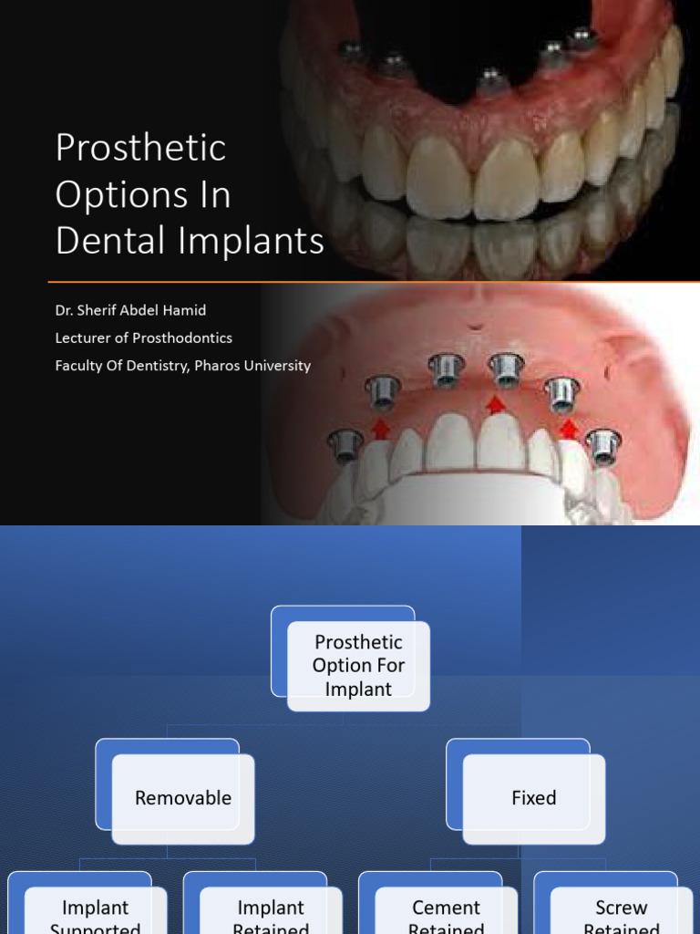 8 - Prosthetic Options in Dental Implants | PDF | Dental Implant | Dentures