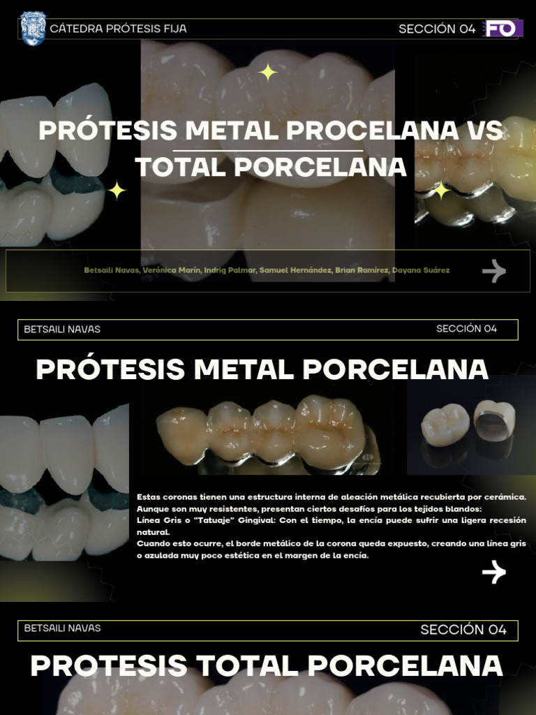 Prótesis Metal-Porcelana (PFM) Comportamiento de La Prótesis Metal