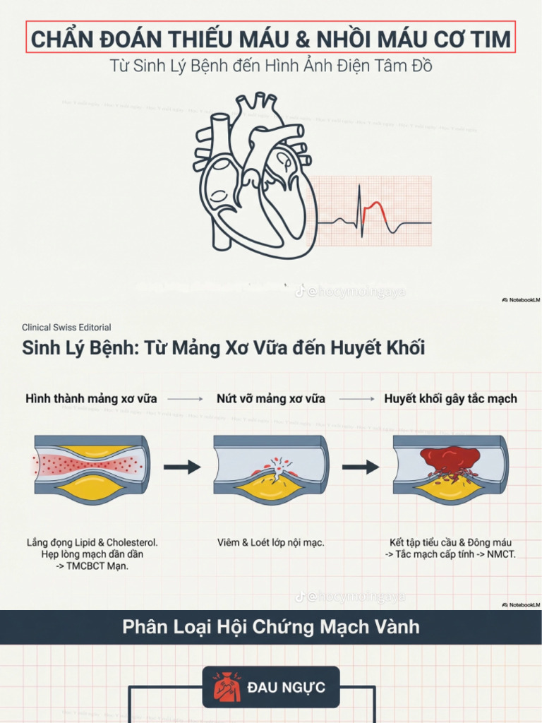 Stemi | PDF