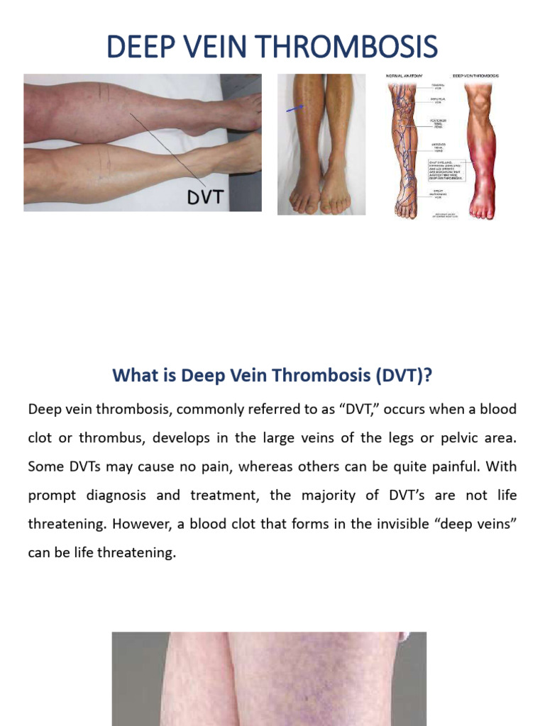 DVT Seminar | PDF
