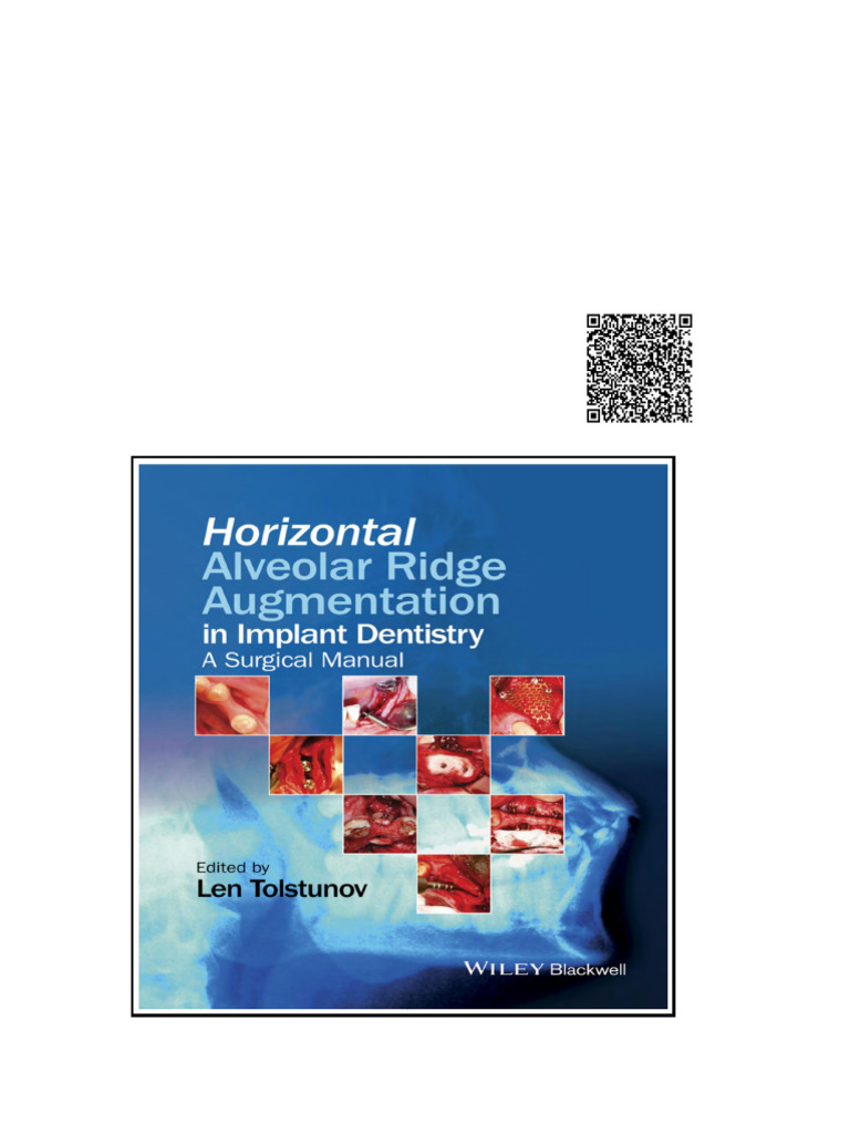 Horizontal Alveolar Ridge Augmentation in Implant Dentistry A nodrm ...