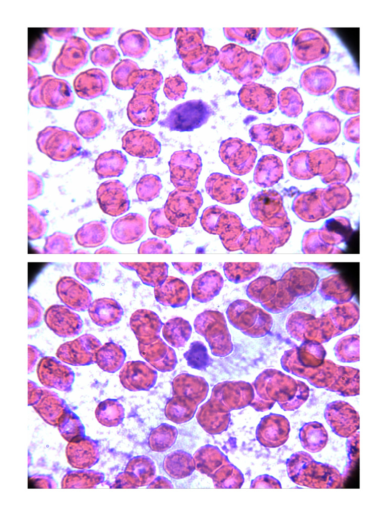 Lympho 2 | PDF