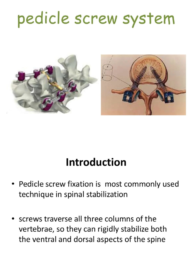 Pedicle Screw | PDF