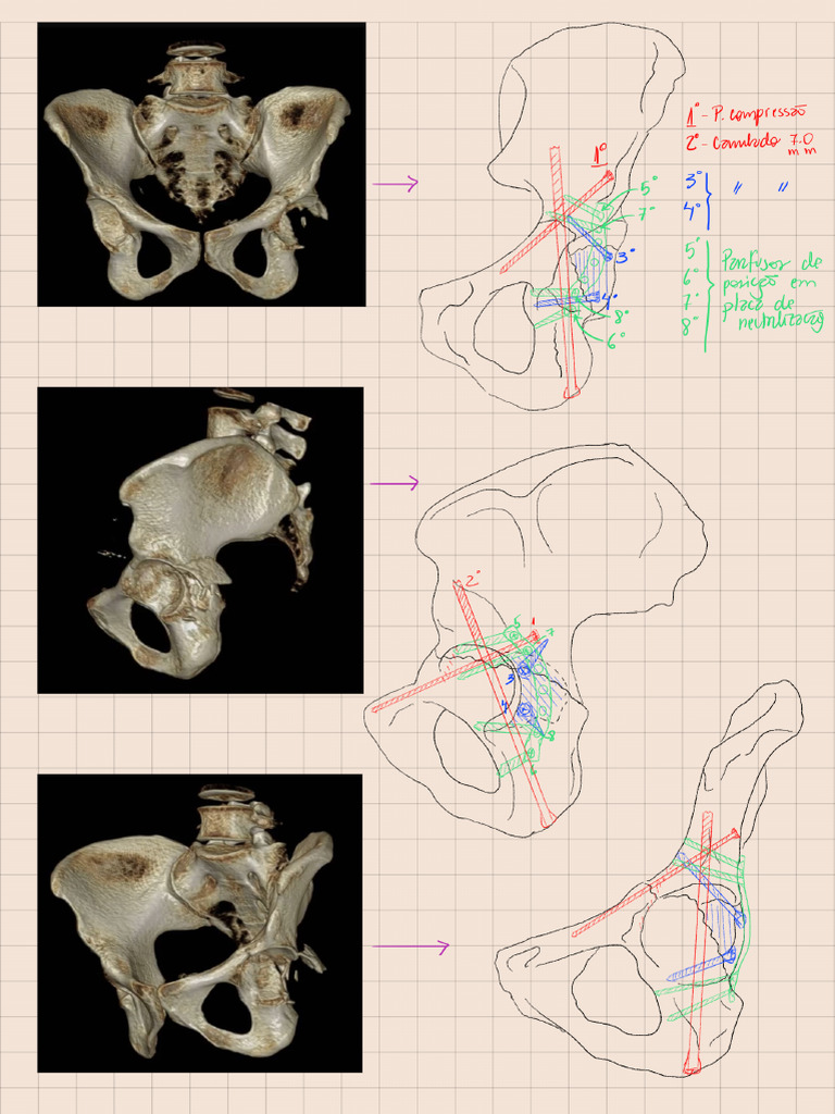 Transverse + Posterior Column Acetabular Fracture - 260211 - 014632 | PDF