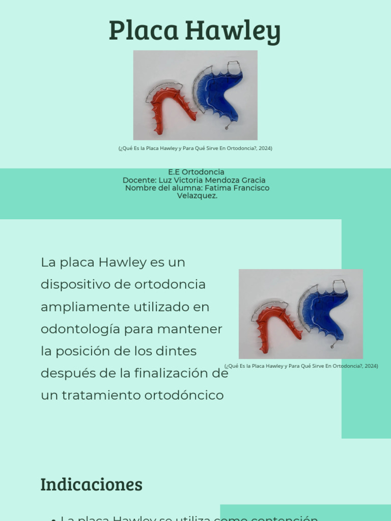 Placa Hawley | PDF | Ortodoncia | Especialidades Medicas