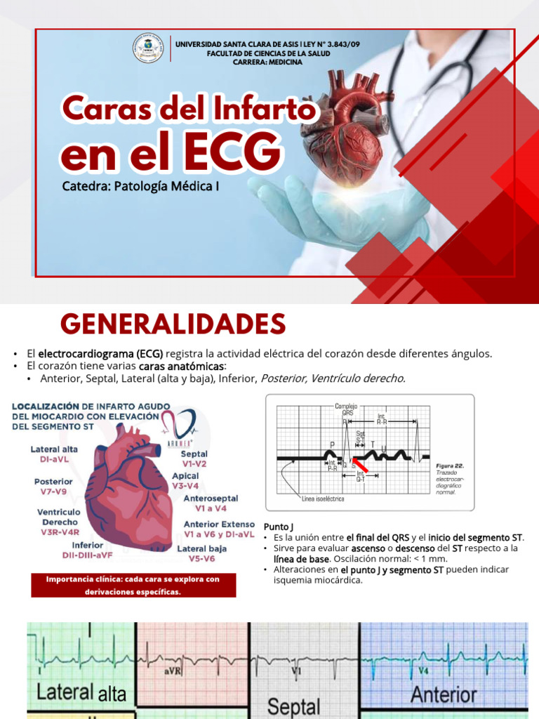 Pato Med Ecg Infarto | PDF | Infarto de miocardio | Enfermedades y ...