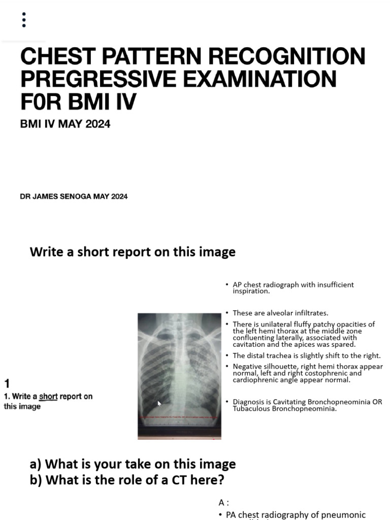 Recap of CXR Pattern Progresive | PDF