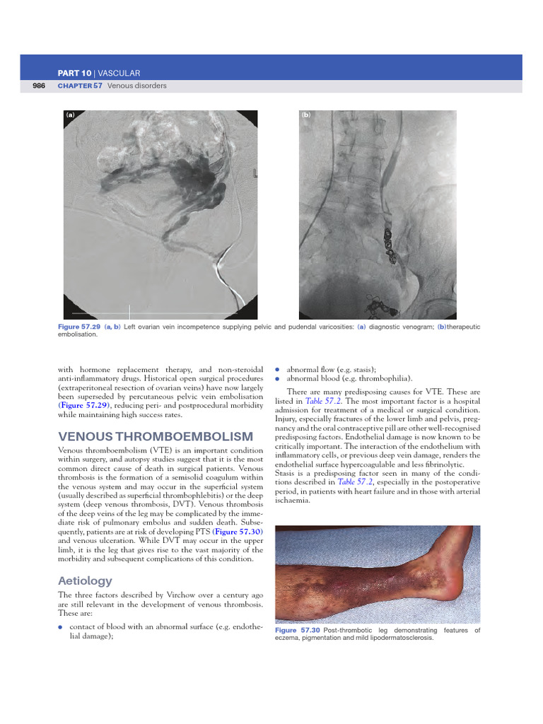 DVT:PE | PDF | Thrombosis | Vein