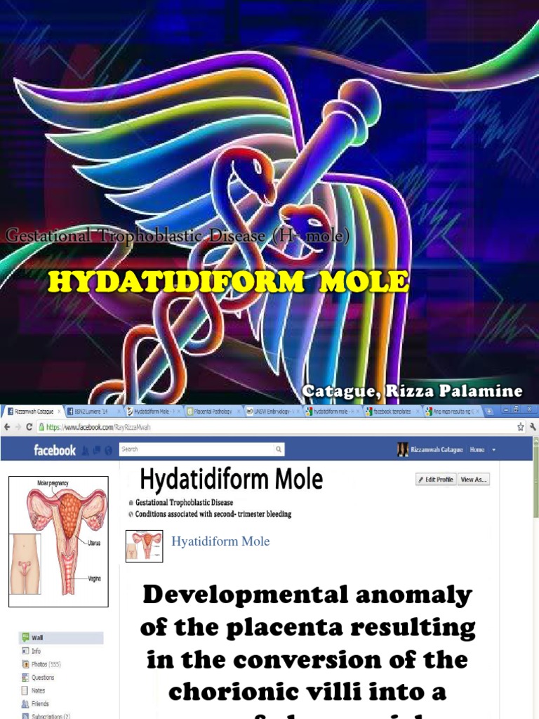 Hydatidiform Mole | PDF | Fetus | Pregnancy