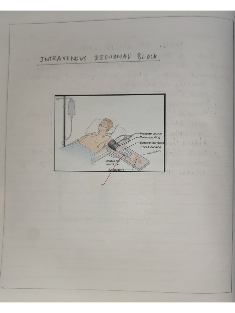 Intravenous Regional Block | PDF