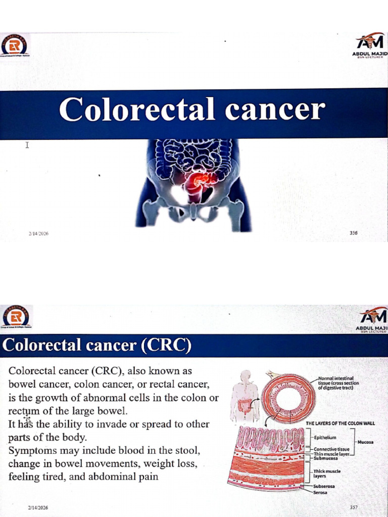 Colorectal Cancer | PDF