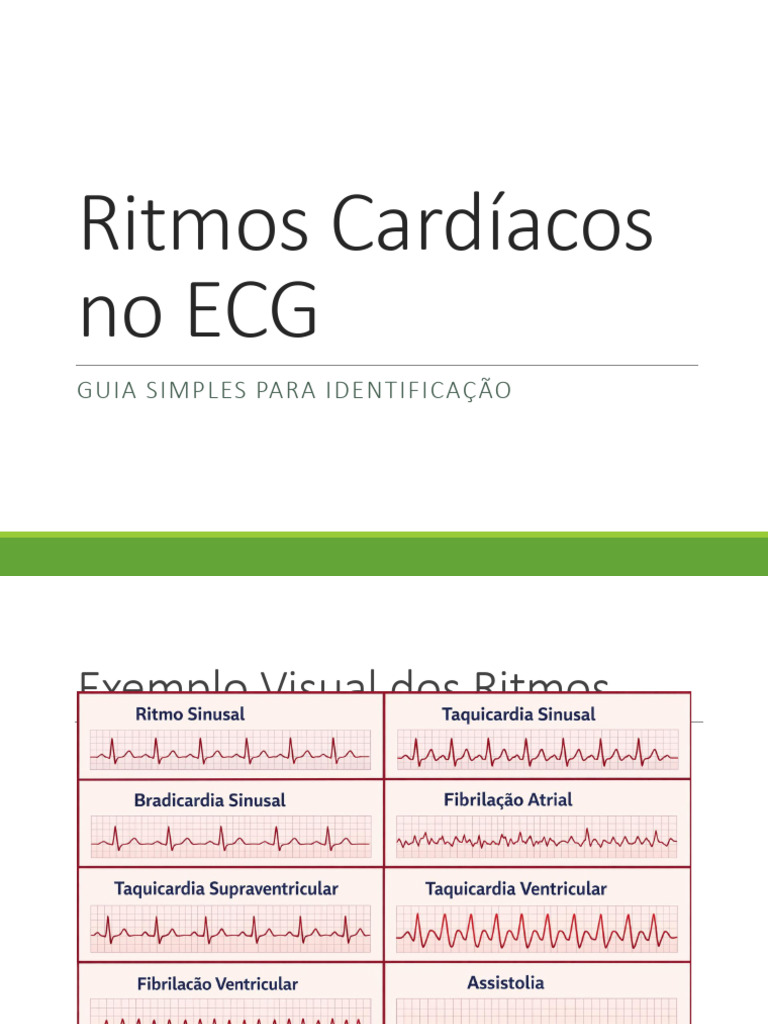 Ritmos Ecg Aula | PDF