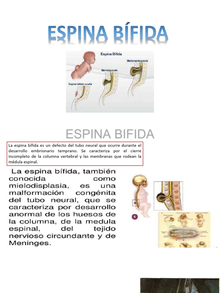 Espina Bifida | PDF