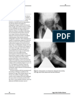 From Toddler to Adolescence: Legg-Calve-Perthes Disease