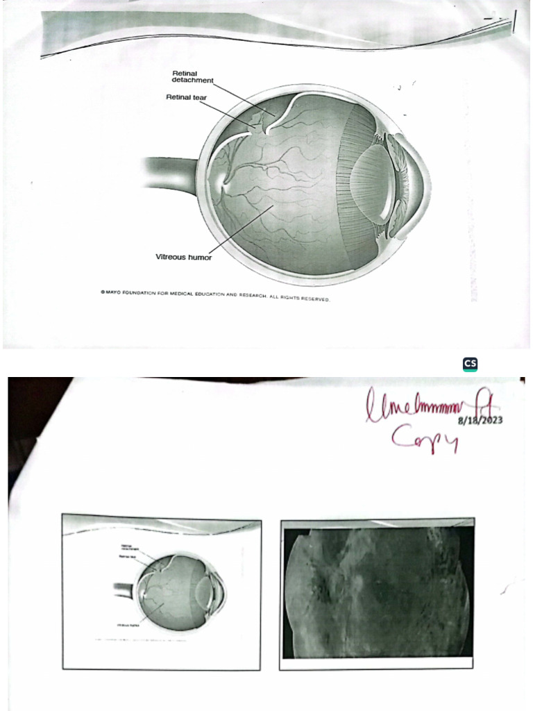 Retinal Detachment | PDF
