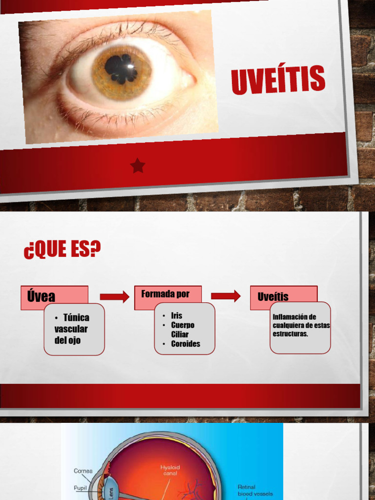 UVEITIS | PDF | Inflamación | Enfermedades y trastornos humanos