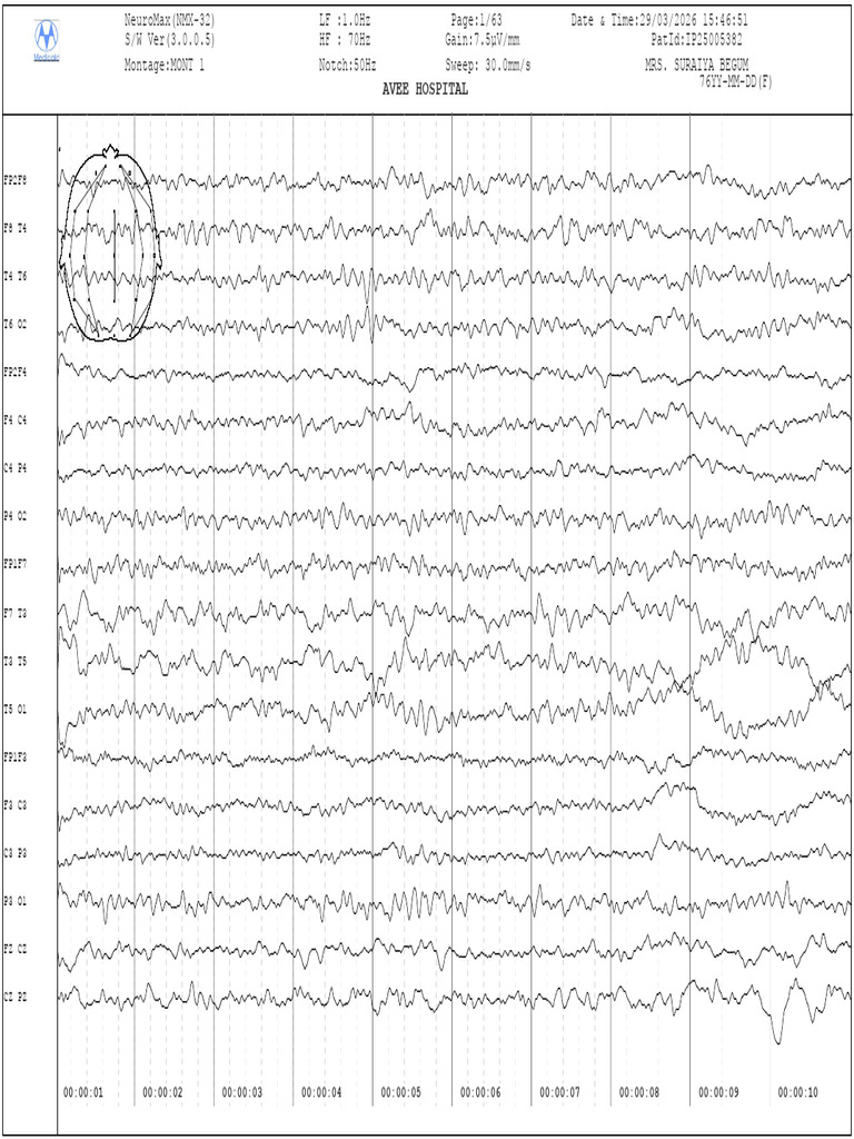Mrs. Suraiya. 76y. Awake Eeg | PDF