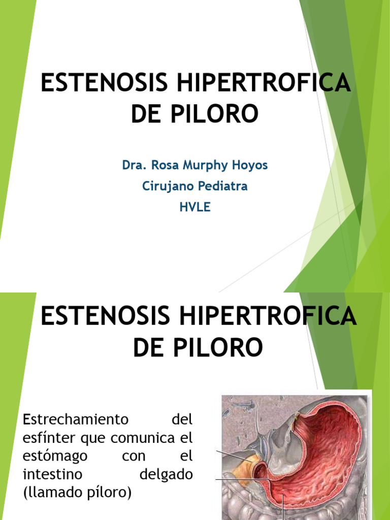 Estenosis Hipertrofica de Piloro: Dra. Rosa Murphy Hoyos Cirujano ...