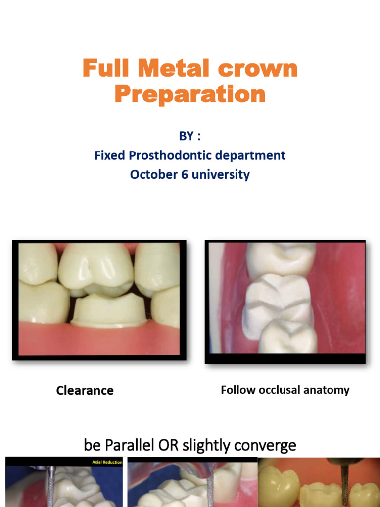 Full Metal Crown Preparation 3rd | PDF