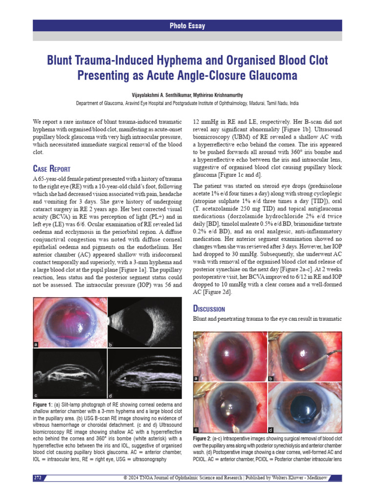 Blunt Trauma Induced Hyphema and Organised Blood.34 | PDF | Glaucoma ...