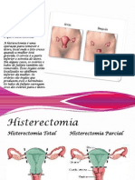 Histerectomia Parcial, Total e Radical