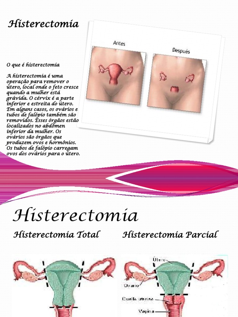 Tipos e Indicações de Histerectomia | PDF | Bem-estar