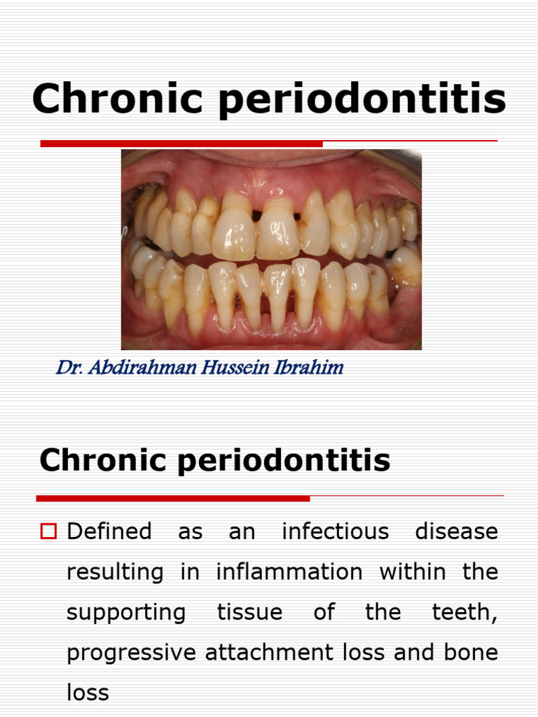 12. Chronic Periodontitis 1 | PDF | Periodontology | Medicine