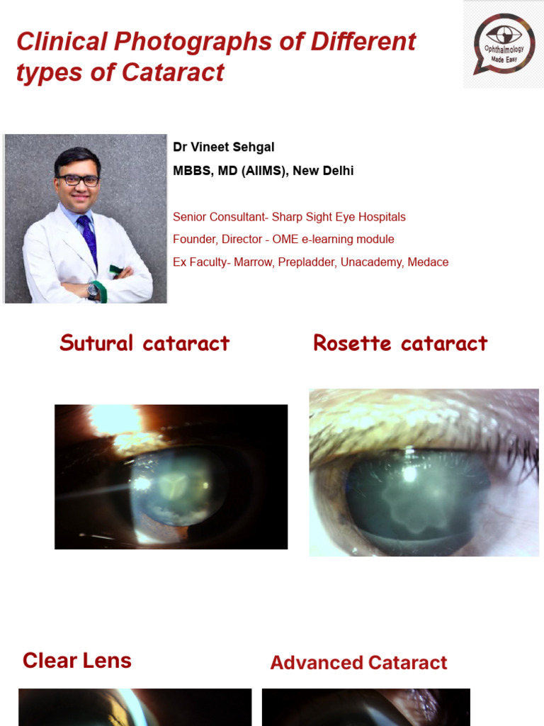 Quick Revision of Types of Cataract for MBBS Students | PDF