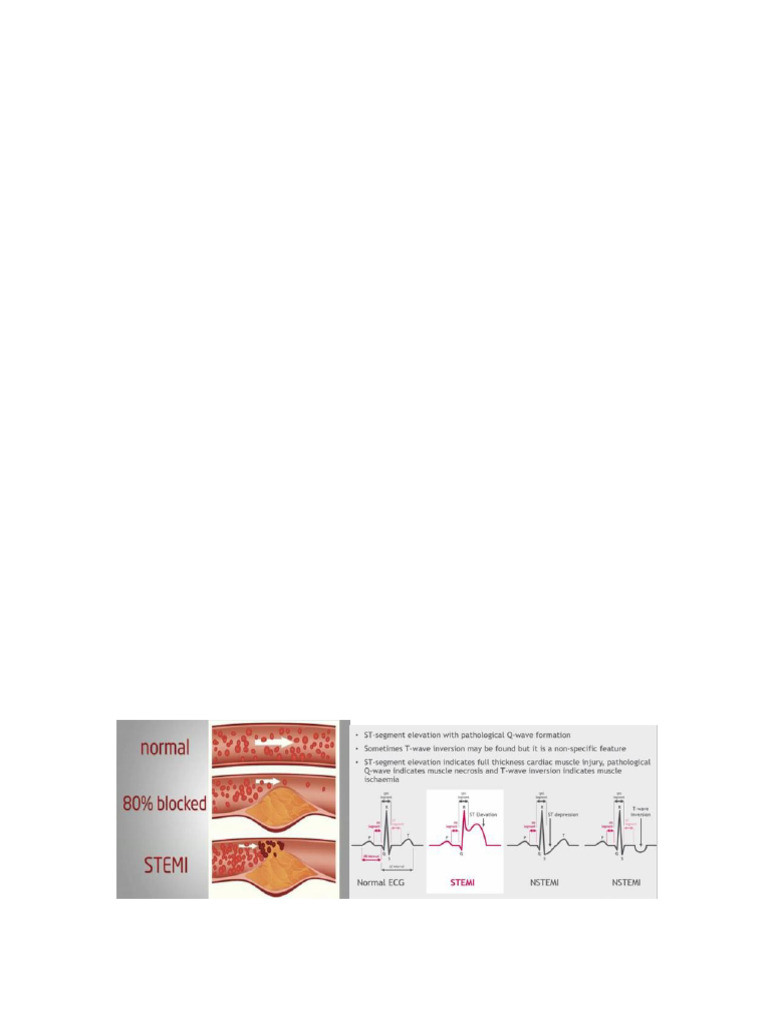 538262329-LP-STEMI | PDF