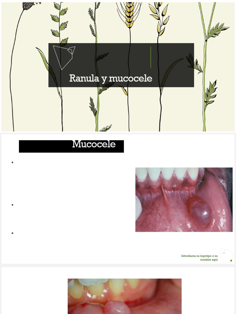 Mucocele y Ranula (1) | PDF | Especialidades Medicas | Enfermedades y ...
