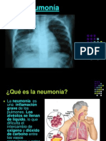 Tarea Neumonia