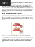 Coronary Artery Disease