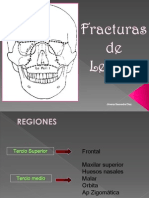 Fracturas de Lefort