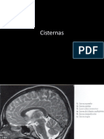 Cisternas perimesencefalicas