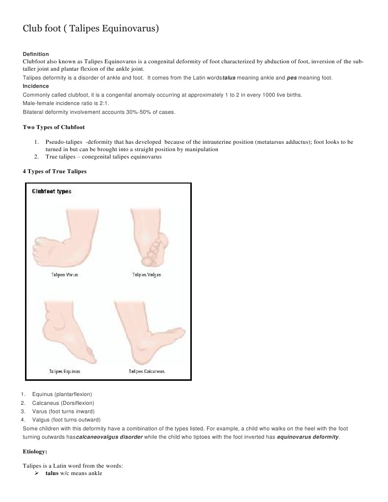 Club Foot Foot Musculoskeletal System